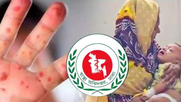 হাম উপসর্গে আরও ৬ জনের মৃত্যু