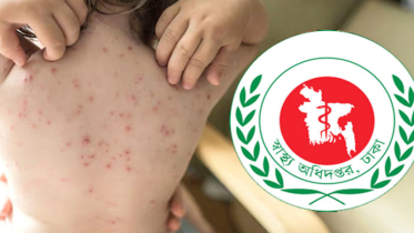 হাম উপসর্গে আরও ৭ জনের মৃত্যু