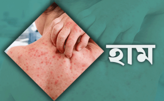 হাম উপসর্গে আরও ৮ মৃত্যু